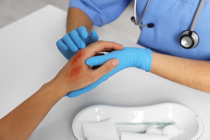 Doctor examining patient's burned hand at table, closeup
