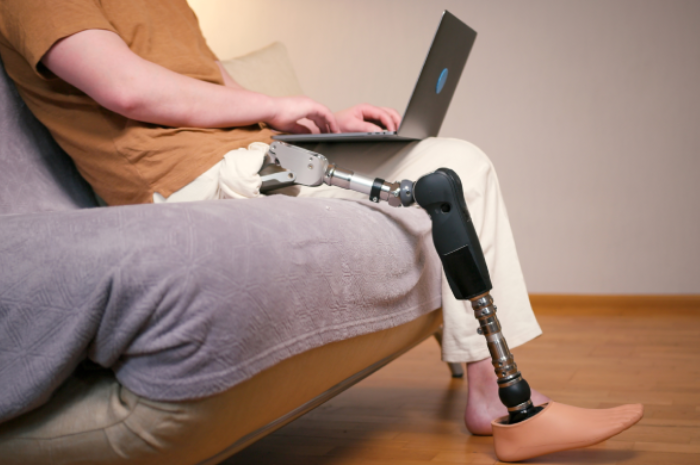 Man amputee with prosthetic leg disability on above knee transfemoral leg prosthesis artificial device using laptop at home.